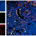 《cell reports》慢性肉芽腫病的發病機制新發現